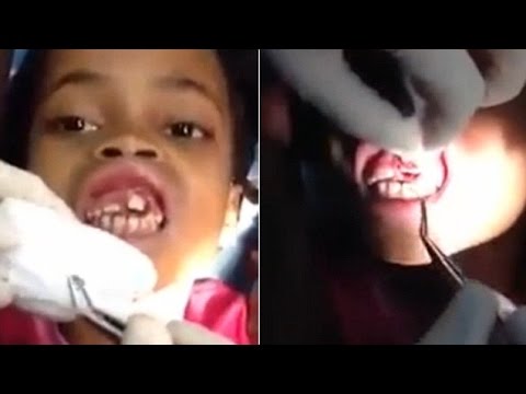 طبيب أسنان يعثر على 15 دودة داخل فم طفلة برازيلية