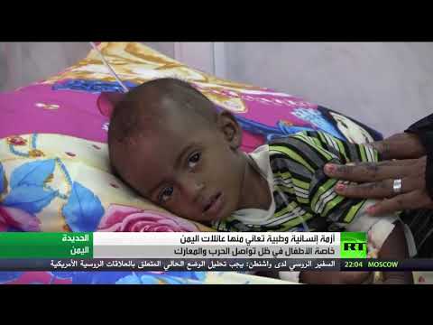 شاهد آلاف الأطفال اليمنيين يعانون سوء التغذية